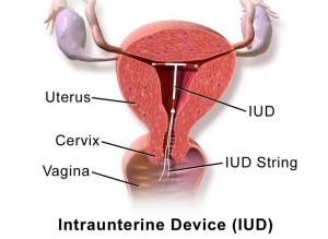 IUD